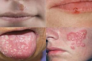 Uçuk (Herpes)