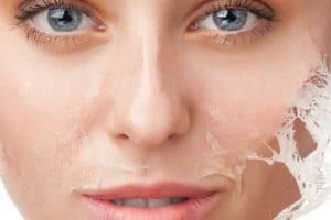 Kimyasal Peeling