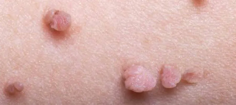 Genital Siğil Tedavisi