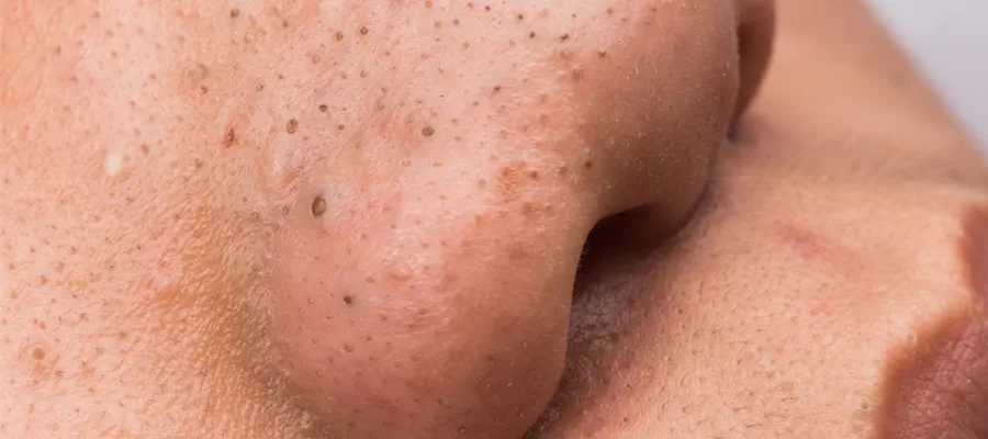 Siyah Nokta