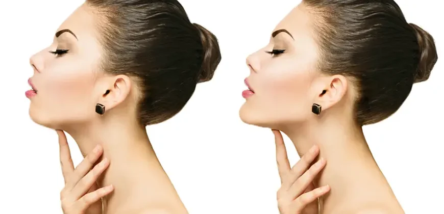 çene dolgusu fiyatları